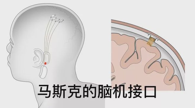 Neuralink的又一里程碑：马斯克确认计划2025年为患者实施脑机接口植入_Neuralink的又一里程碑：马斯克确认计划2025年为患者实施脑机接口植入_Neuralink的又一里程碑：马斯克确认计划2025年为患者实施脑机接口植入